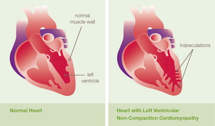 left ventricular non compaction
