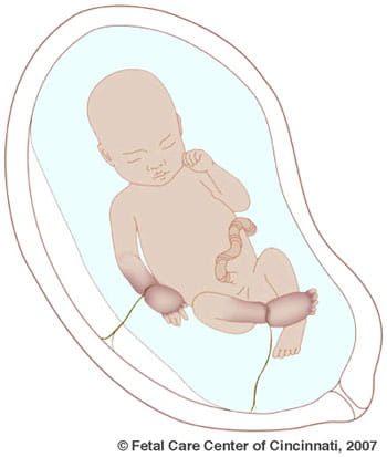 Amniotic Band Syndrome Abs Fetal Care Center Amniotic Band Syndrome Abs Fetal Care Center