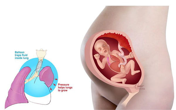 Fetoscopic Endoluminal Tracheal Occlusion Feto To Treat Cdh Fetal Care Center