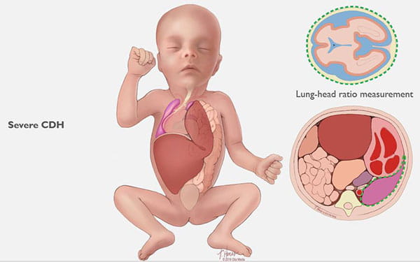what is cdh in unborn babies