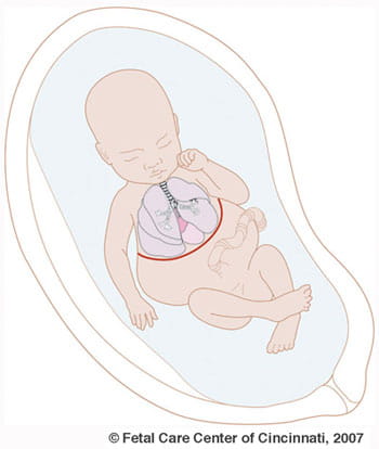 Congenital High Airway Obstruction Syndrome Chaos Fetal Care Center Congenital High Airway Obstruction Syndrome Chaos Fetal Care Center