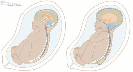 myelomeningocele spina bifida fetal repair cincinnati fetal myelomeningocele repair