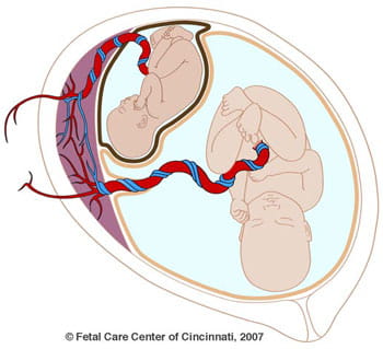 Twin-Twin Transfusion Syndrome (TTTS) Twin-Twin Transfusion Syndrome (TTTS)