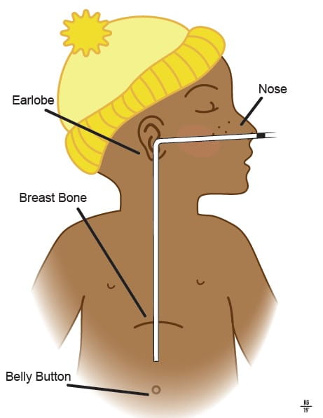 Spanish image of Insertion of Silastic Nasogastric Feeding Tube