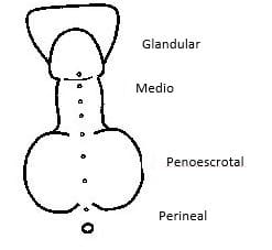 hipospadias-y-encordamiento-image