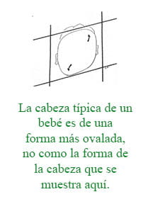 Plagiocefalia