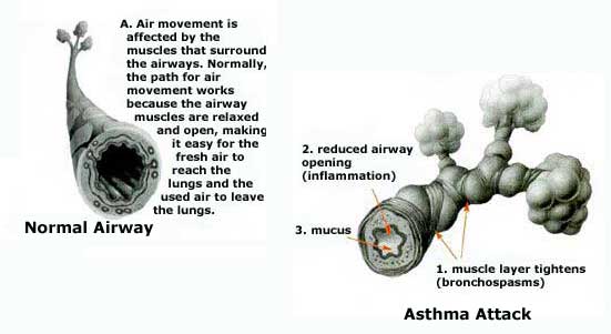 Normal airways and airways with bronchospasms.