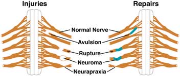 Diagram showing types of brachial plexus injuries.