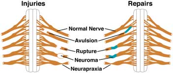 Diagram showing types of brachial plexus injuries.