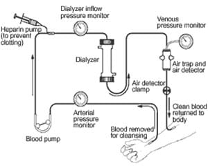 Hemodialysis diagram.