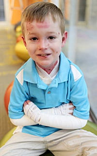 Boy with epidermolysis bullosa.