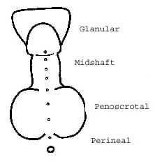 Hypospadias