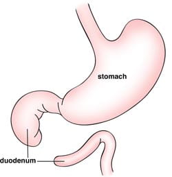 Duodenal Atresia