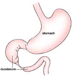 Duodenal Atresia