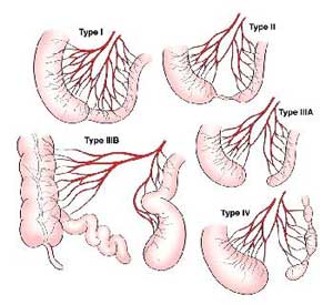 Jejunoileal Atresia