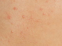 Molluscum contagiosum.