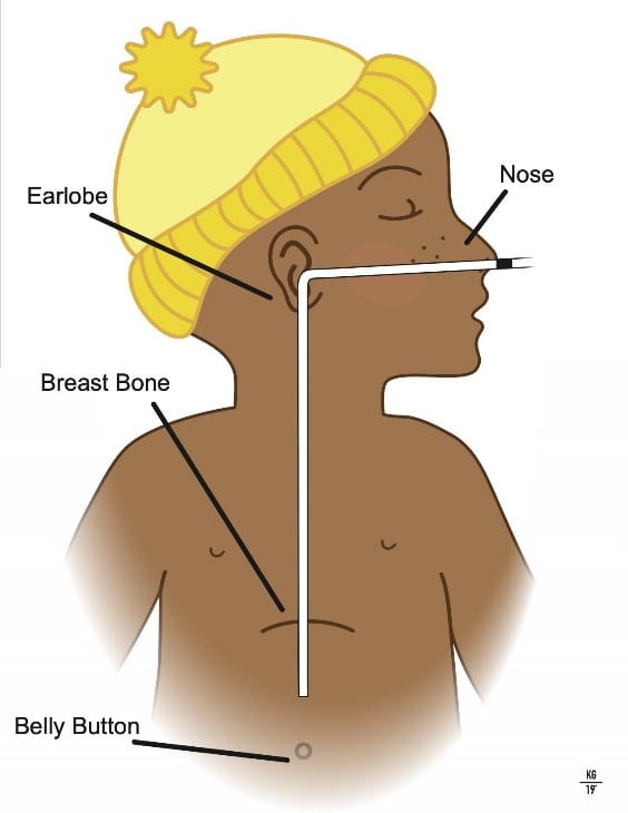 Nasogastric Tube Feeding Using a Feeding Pump