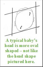 Appearance of head with plagiocephaly.