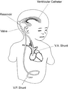 VP Shunts (for Parents) - Nemours KidsHealth