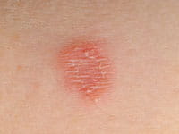 Tinea capitis, or ringworm.