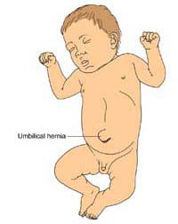 What does an umbilical hernia look like?