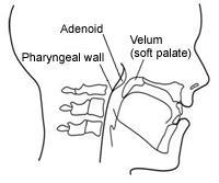 Figure 5.  Adenoids in the pharynx (throat).