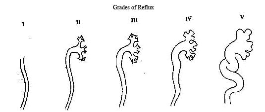 Grades of Reflux.