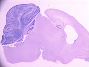 Medulloblastoma formation in the mouse cerebellum.