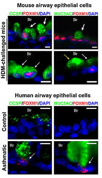 Foxm1 transcription factor is expressed in subsets of airway Clara cells and goblet cells of patients with severe asthma as well as lungs of mice with experimental asthma.